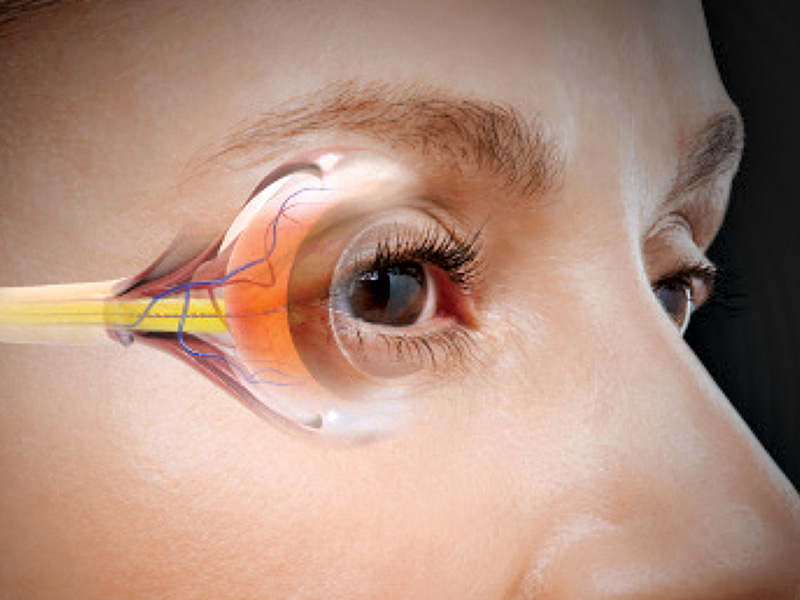 Глаукома: опасное заболевание глаз