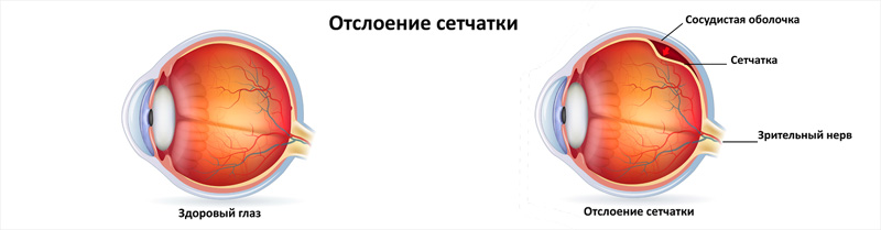 Отслоение сетчатки: Напоминание о важности своевременной диагностики и лечения